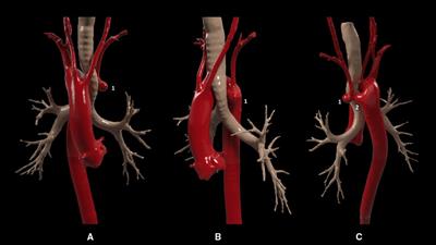 Case Report: Kommerell's diverticulum and left aberrant subclavian artery stenosis hybrid treatment with branched aortic stent-graft